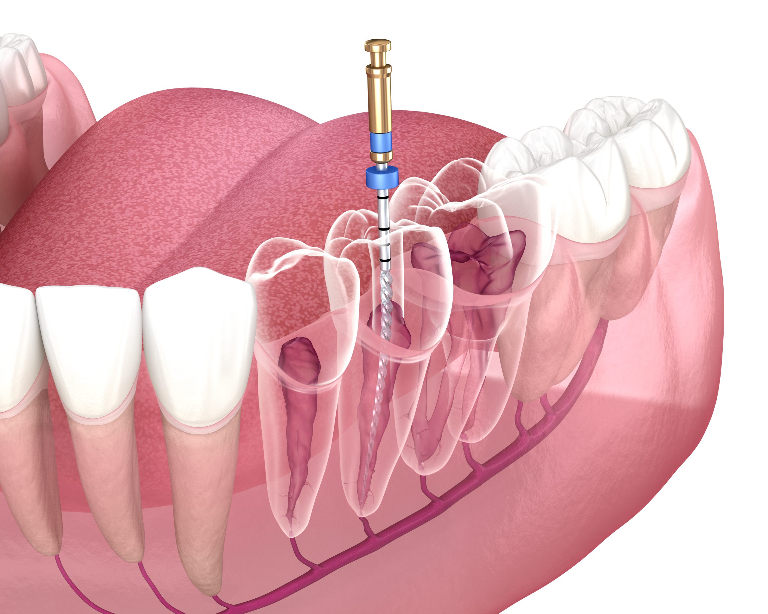 Peoria Root Canal Therapy