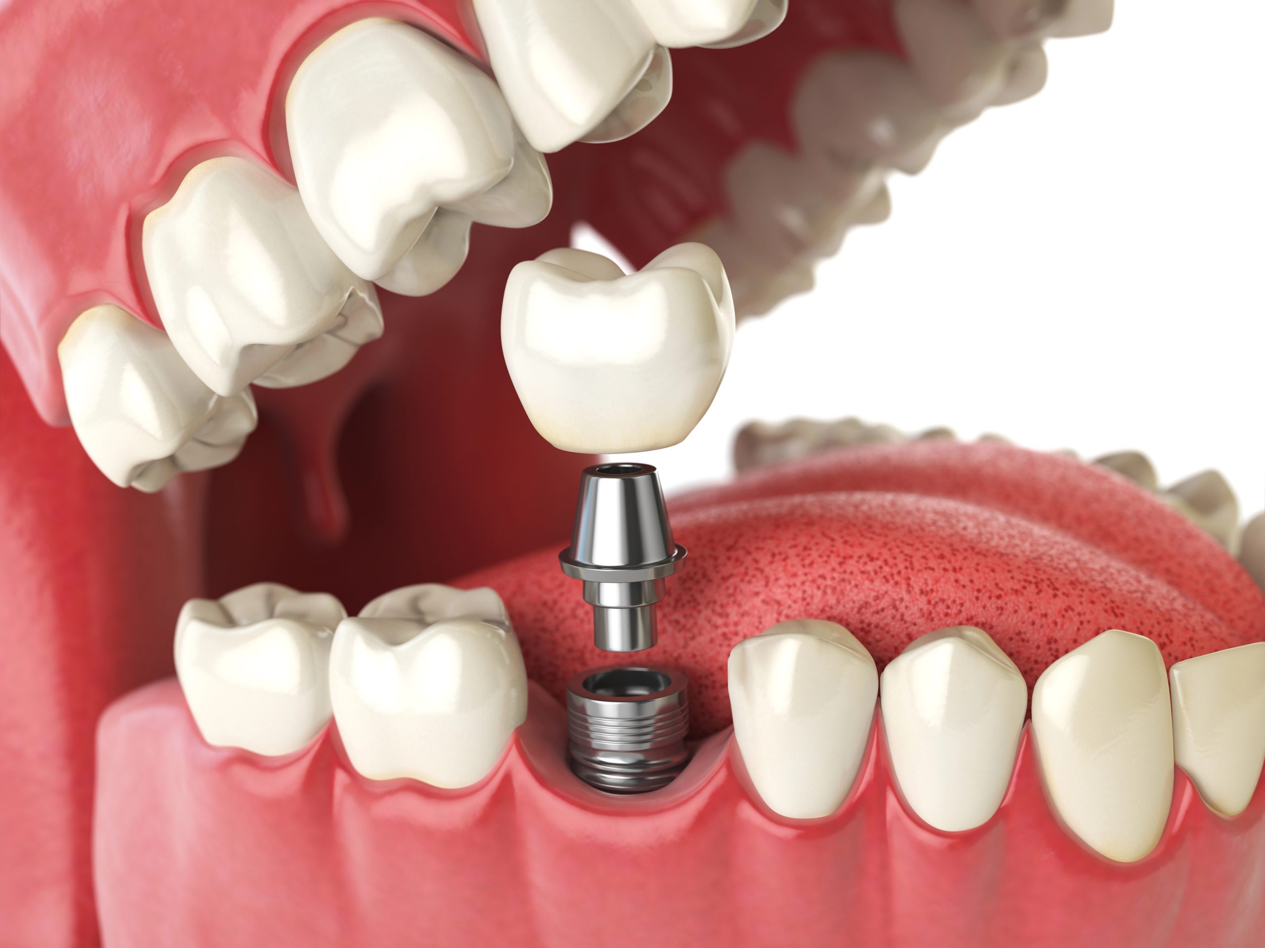 Dawson Dental in Peoria, AZ offering dental implant surgery