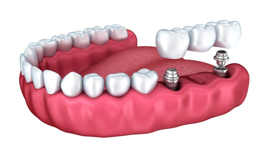 Peoria Dental Implants - Dawson Dental